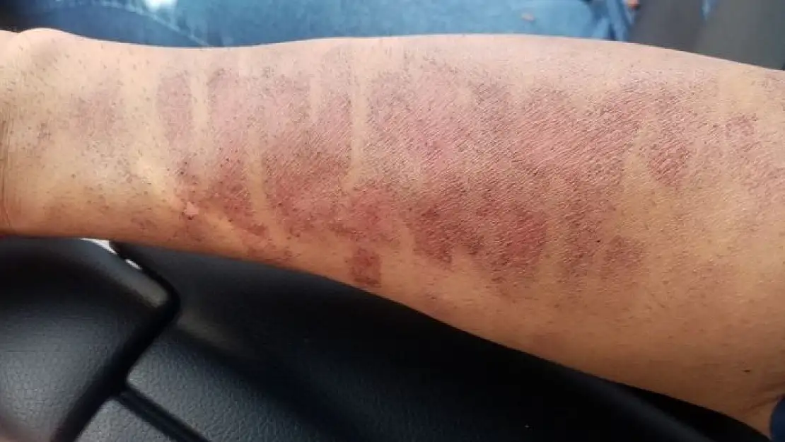 'Lazer epilasyon yaptırdı, kolları yandı'