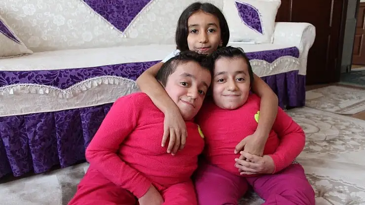 'Cam kemik hastası ikizlerden birinin kemiği kırılınca diğeri de hissediyor'