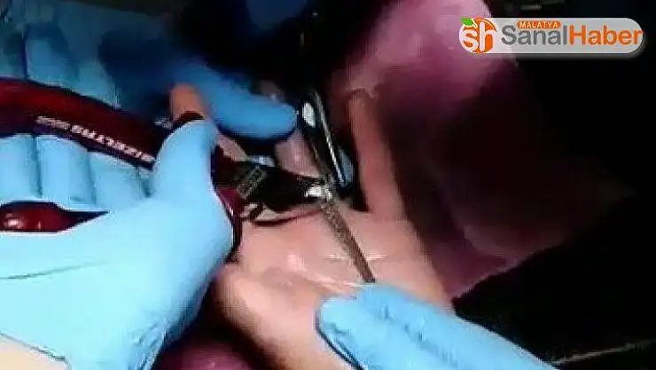 Parmağa sıkışan yüzüğü itfaiye çıkarttı